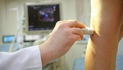 Laserowe leczenie żylaków